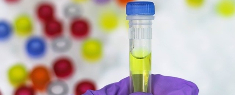 Nuevo método para diagnóstico de cáncer de vejiga.