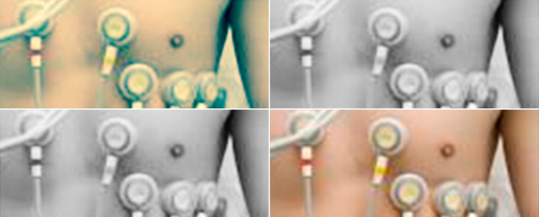 PEDIATRICO: Dispositivo CV pediátrico Quick-ECG